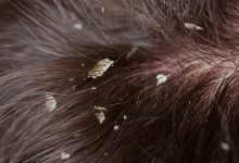 درمان خانگی شپش موی سر